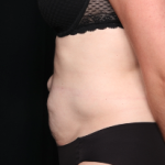 Tummy Tuck Before & After Patient #34348